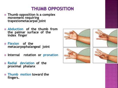 Ape thumb deformity to publish