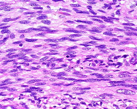 Figure 6 from Spindle Cell Sarcomas. | Semantic Scholar