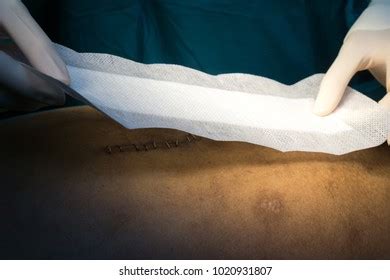 Laparotomy Images, Stock Photos & Vectors | Shutterstock