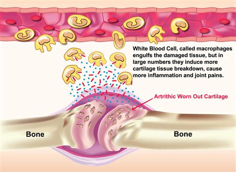 Joint Inflammation Relief