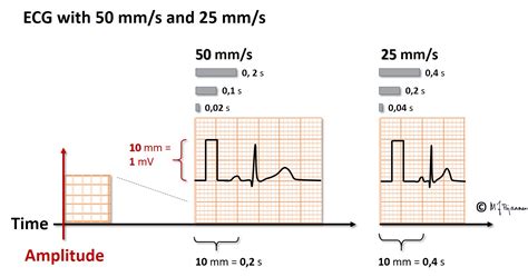 On Ecg Graph Paper An Upward Deflection Represents - Free Printable Paper