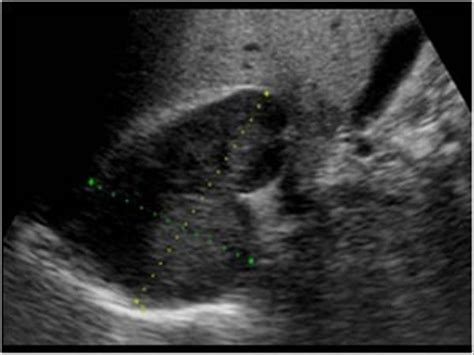 Abdomen and retroperitoneum | 1.10 Adrenal glands : Case 1.10.7 Adrenal carcinoma | Ultrasound Cases