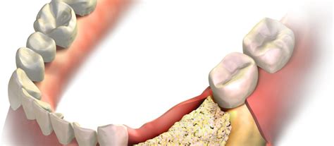 Autograft vs. Allograft - Dr. William Lane