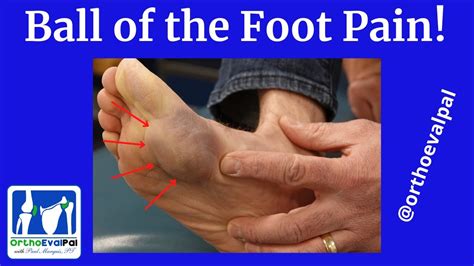 Ball of the Foot Pain - YouTube