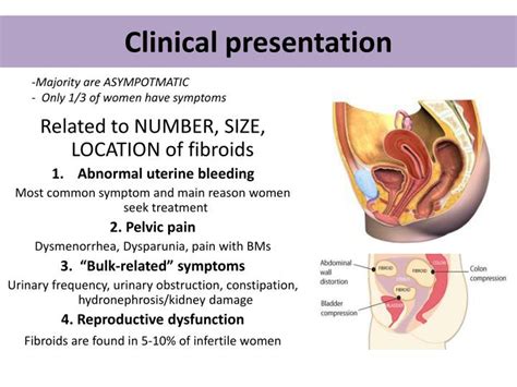 PPT - Uterine Leiomyoma PowerPoint Presentation - ID:2372404