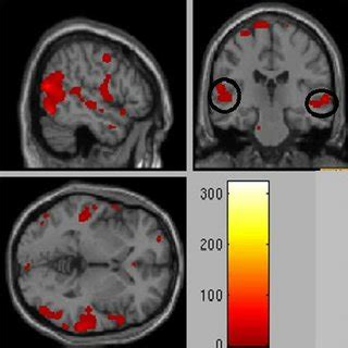 A case of temporal lobe epilepsy with bilateral mesial temporal... | Download Scientific Diagram