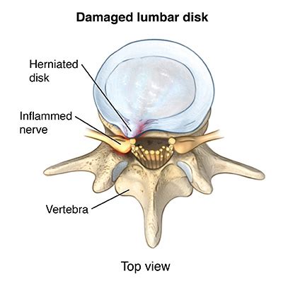 Radiculopathy | Johns Hopkins Medicine