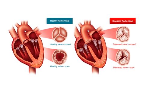 What Are Aortic Stenosis Symptoms And Causes? C Raghu, 50% OFF