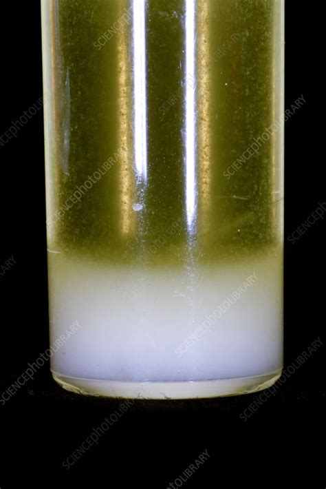 White blood cells in urine sample - Stock Image - C026/9208 - Science Photo Library