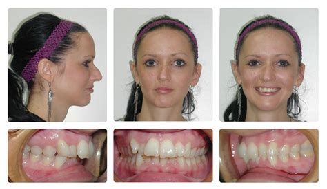 Orthodontic Before and After Photos | Brodsky Orthodontics