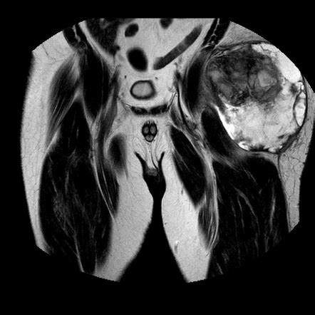 Malignant fibrous histiocytoma | Image | Radiopaedia.org