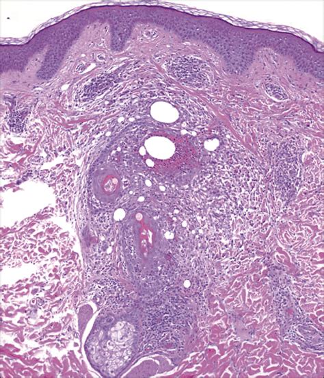 Pathology Outlines - Eosinophilic pustular folliculitis