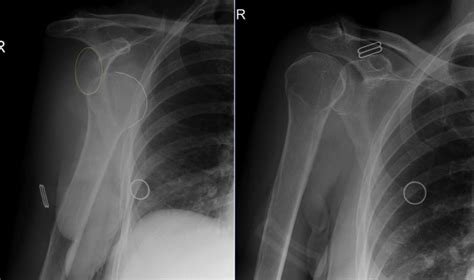 Anterior shoulder dislocation - Radiology at St. Vincent's University Hospital