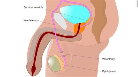 What Is Involved In A Vasectomy Procedure