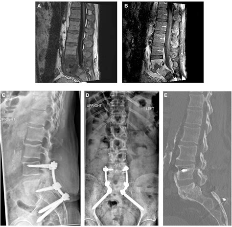 Frontiers | Rigid Posterior Lumbopelvic Fixation without Formal ...