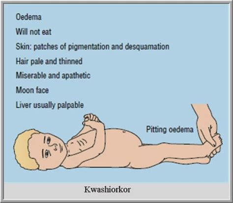 CA native: Kwashiorkor and Marasmus Put into Perspective