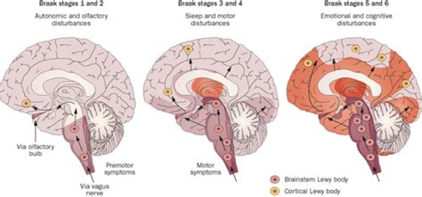 polvere Allungare Continuo what causes lewy body dementia Di base ...