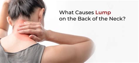 What Causes Lump on the Back of Neck? 5 Effective Home Remedies