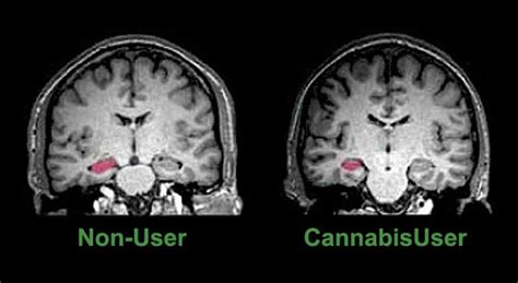 Marijuana’s Long Term Effects On The Brain Finally Revealed!