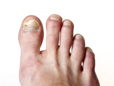 Onychomycosis/Toenail Infection: 10 Must-Try Home Remedies