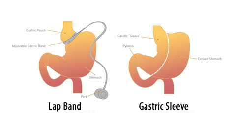 Lap Band Surgery - How It Works? - Weight Loss Surgery