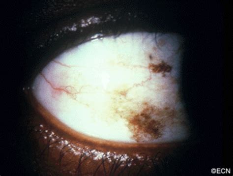 melanosis eye - pictures, photos