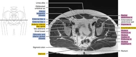 MRI of the male pelvis | Radiology Key