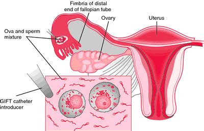 Gamete Intrafallopian Tube Transfer - GIFT Treatment, Kerala | KJK Infertility Treatment