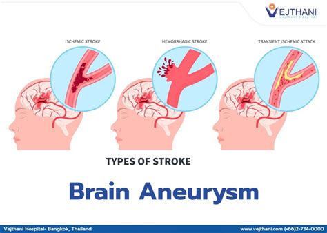 Overview of Brain Aneurysm