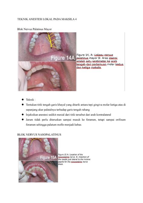 Teknik Anestesi Lokal Pada Maksila 4 - TEKNIK ANESTESI LOKAL PADA MAKSILA 4 Blok Nervus ...