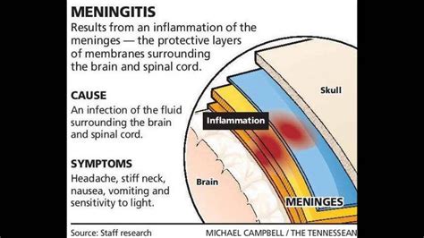 Fungal Meningitis - YouTube