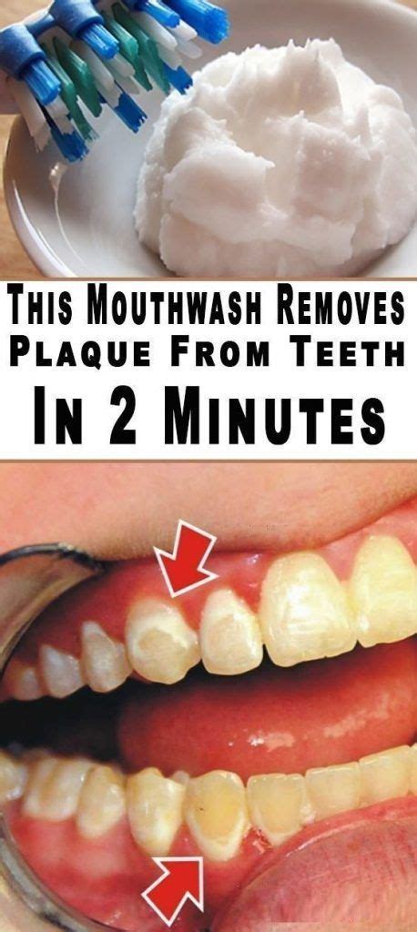 This Mouthwash Removes Plaque From Teeth In 2 Minutes – Green Holistic ...