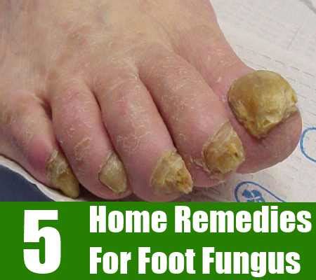 Home Remedies For Foot Fungus – Natural Home Remedies & Supplements