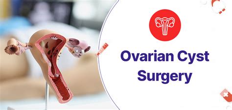 An In-Depth Look At Ovarian Cyst Surgery - Gmoney.in