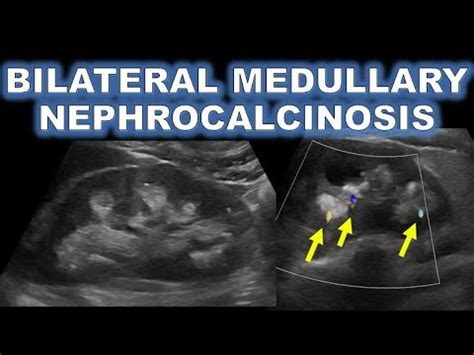 MEDULLARY NEPHROCALCINOSIS ON ULTRASOUND - YouTube