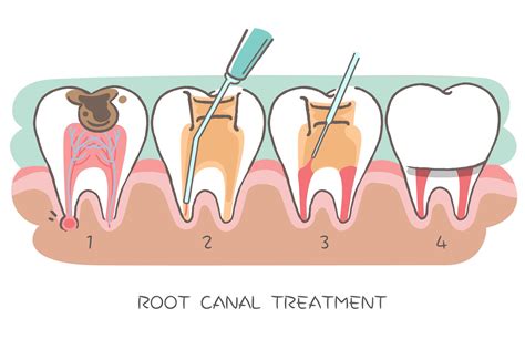 Have questions about root canal treatment? We have answers!