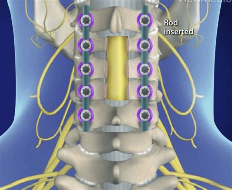 Laminectomy Procedure - Florida Surgery Consultants