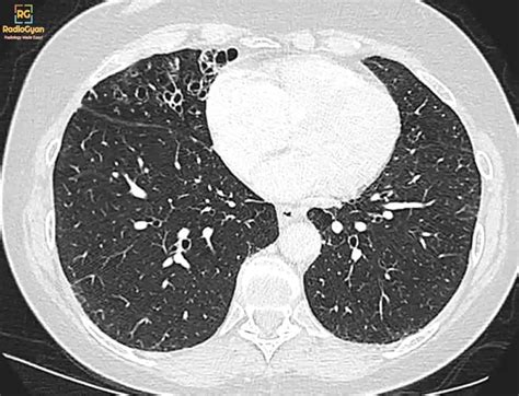 Imaging of Hemoptysis | Radiology Board Review Case