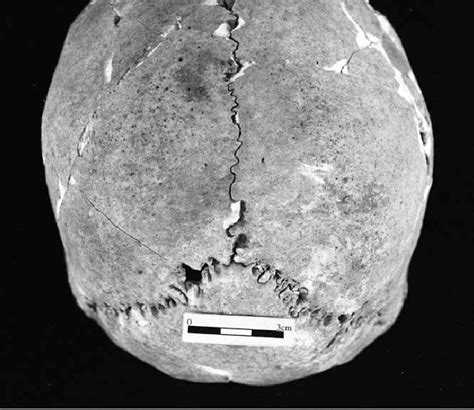 Porotic hyperostosis of parietals on Skull 2. | Download Scientific Diagram