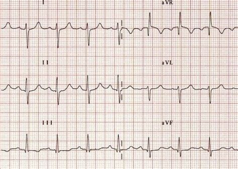 Right Axis Deviation Ecg - Simple Education / The mean qrs axis during ...