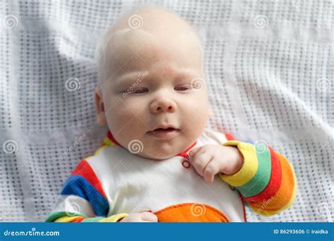 Whitehair Babyboy with Albinism Syndrome Stock Photo - Image of medical ...