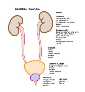 Hematuria - WikEM