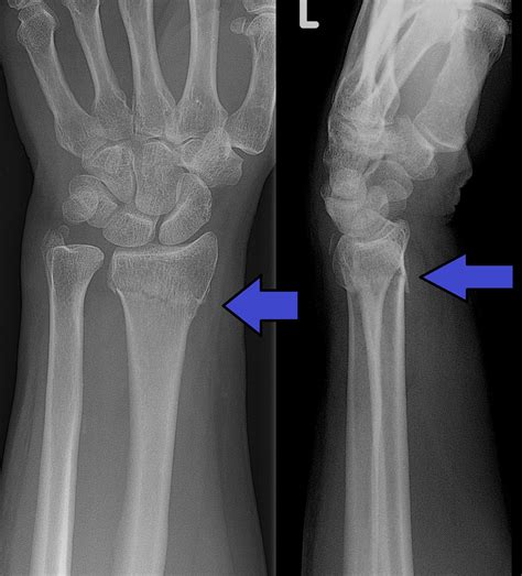 橈骨遠端骨折 Distal Radius Fracture: 最新的百科全書、新聞、評論和研究