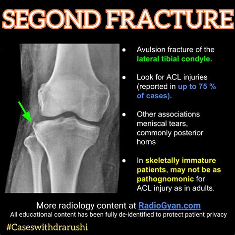 Segond fracture – Artofit