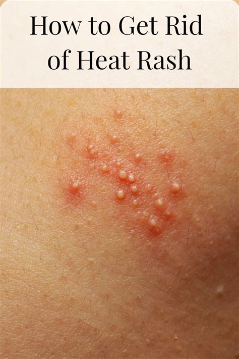 How to Get Rid of Prickly Heat (Heat Rash) | Heat rash, Prickly heat ...