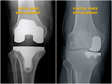 Partial (Unicondylar) Knee Replacement - Orthoist