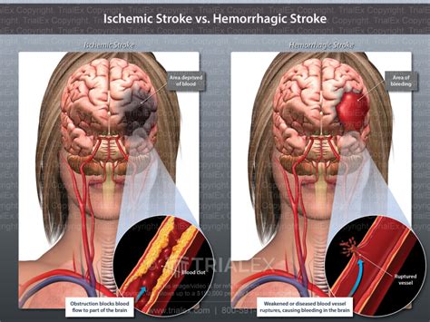 Ischemic Stroke vs. Hemorrhagic Stroke - TrialQuest Inc.