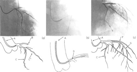 A, Coronary angiography catheter in the ascending aorta, its tip in the... | Download Scientific ...