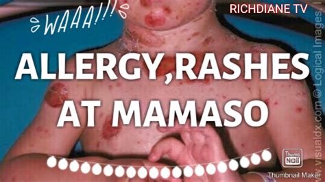 RASHES AT MAMASO SA BALAT | SKIN ALLERGY / CAUSE OF ALLERGY - YouTube