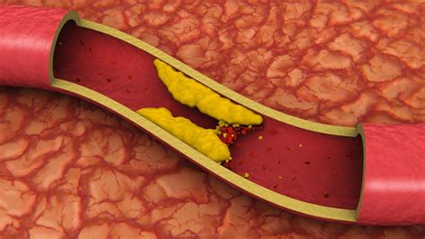 Clogged arteries may be down to bacteria, not diet